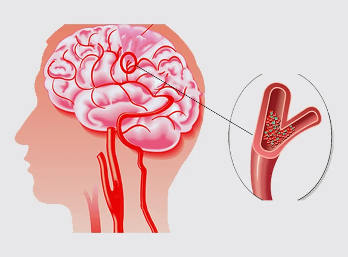 TIA (Transient Ischemic Attack)